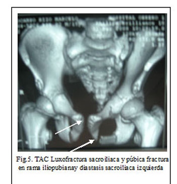 Revista SCientifica - fractura pelvis en libro abierto y presentación de casos